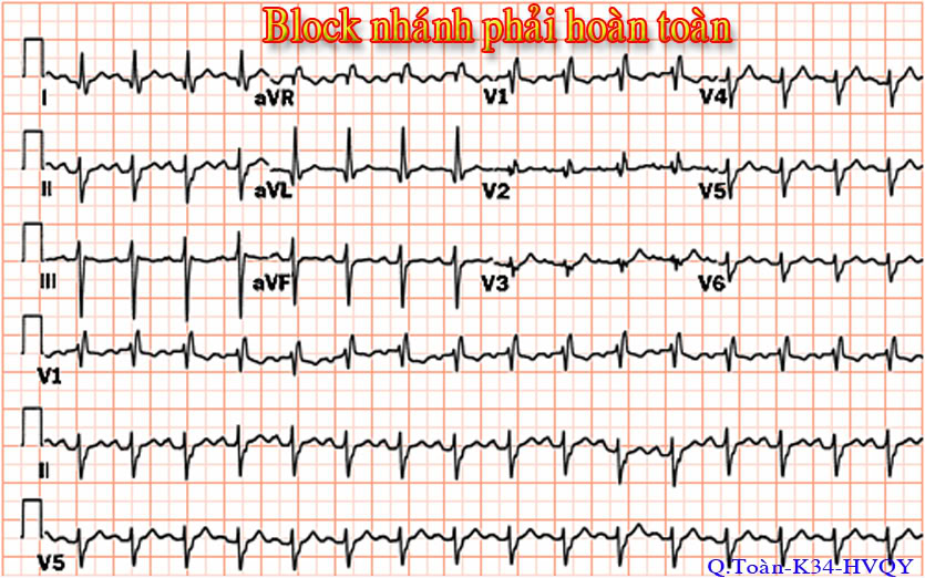 ĐIỆN TÂM ĐỒ – Chủ đề 3: RL dẫn truyền trong thất RBBB1