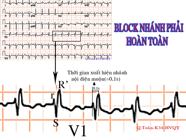 ĐIỆN TÂM ĐỒ – Chủ đề 3: RL dẫn truyền trong thất RBBB3