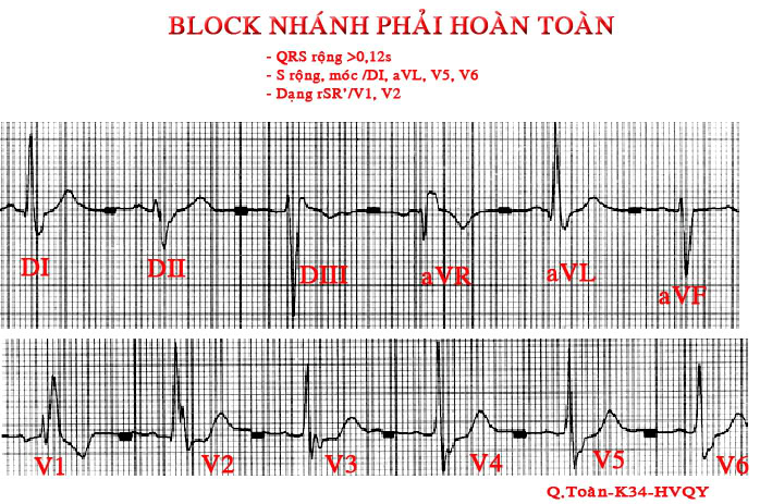 ĐIỆN TÂM ĐỒ – Chủ đề 3: RL dẫn truyền trong thất RBBB5