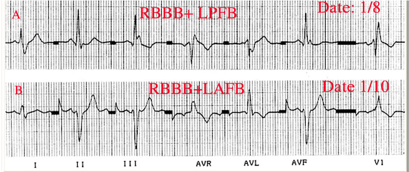 ĐIỆN TÂM ĐỒ – Chủ đề 3: RL dẫn truyền trong thất RBBBLPBB