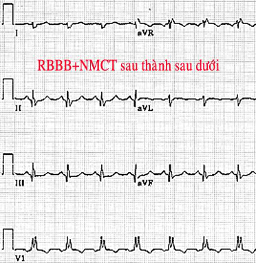 ĐIỆN TÂM ĐỒ – Chủ đề 3: RL dẫn truyền trong thất RBBBNMCTsauduoi2