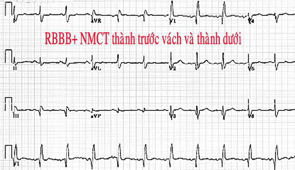 ĐIỆN TÂM ĐỒ – Chủ đề 3: RL dẫn truyền trong thất RBBBNMCTtruocvachvathanhduoi