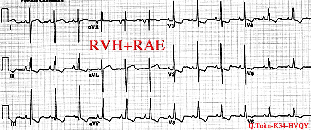 ĐIỆN TÂM ĐỒ – Chủ đề 3: RL dẫn truyền trong thất RVHRAE