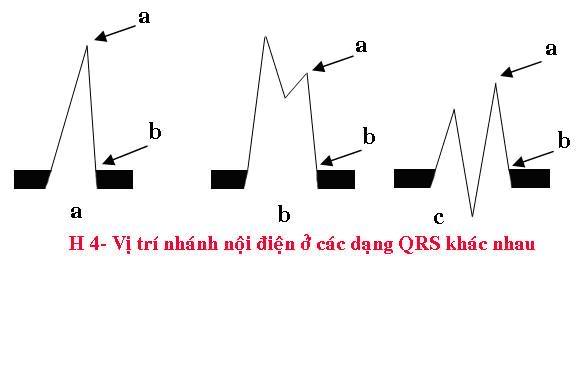 ĐIỆN TÂM ĐỒ – Chủ đề 3: RL dẫn truyền trong thất Noidien1