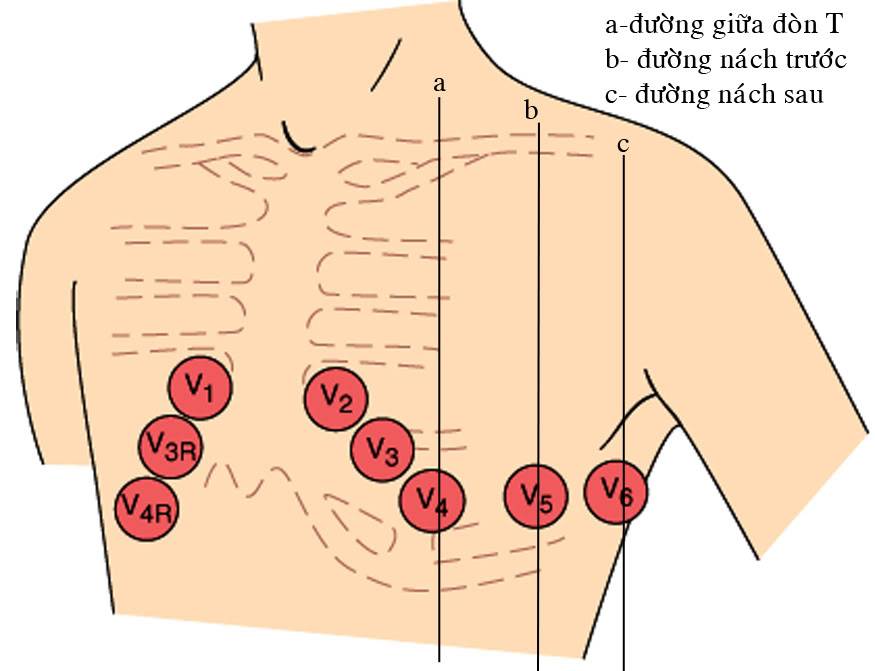 ĐIỆN TÂM ĐỒ – Chủ đề 3: RL dẫn truyền trong thất 3