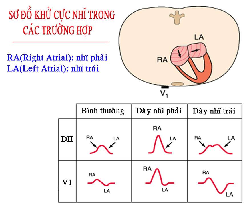 ĐIỆN TÂM ĐỒ – Chủ đề 3: RL dẫn truyền trong thất LAE1