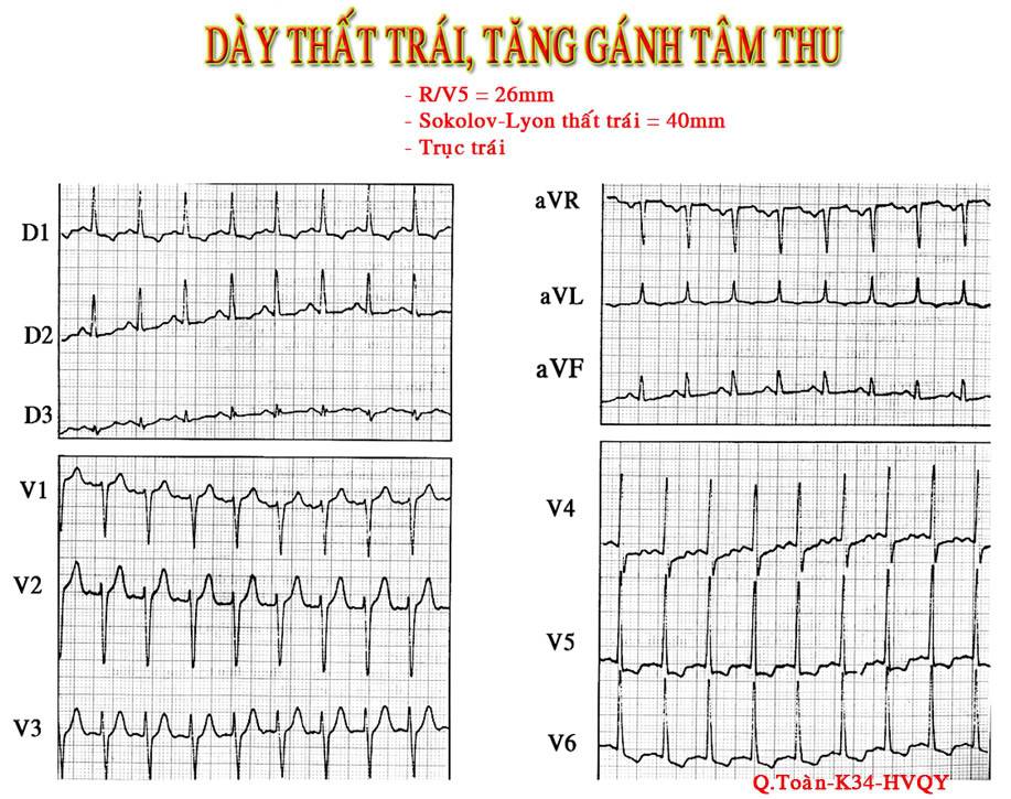 ĐIỆN TÂM ĐỒ – Chủ đề 3: RL dẫn truyền trong thất LVH1-1