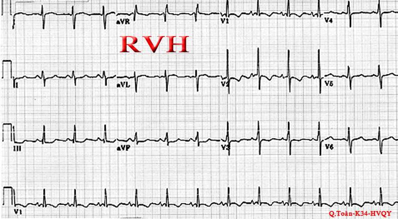 ĐIỆN TÂM ĐỒ – Chủ đề 3: RL dẫn truyền trong thất RVH2-1