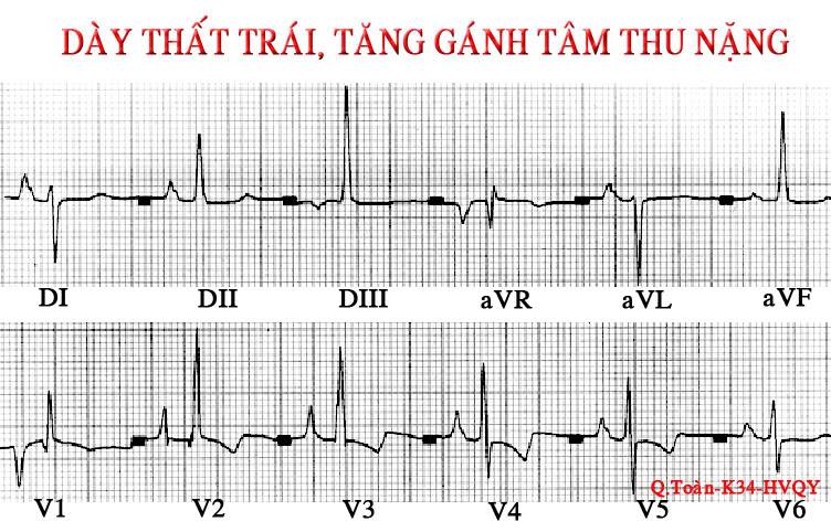 ĐIỆN TÂM ĐỒ – Chủ đề 3: RL dẫn truyền trong thất RVH4