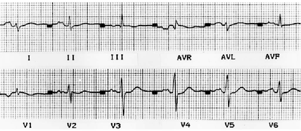 ĐIỆN TÂM ĐỒ – Chủ đề 3: RL dẫn truyền trong thất RVH5-1