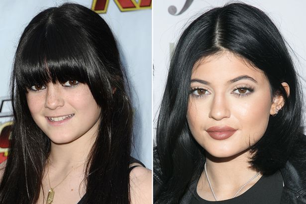 Kylie Jenner Kylie-Jenners-changing-lips