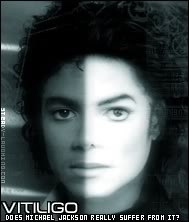 Sự thật về Làn da trắng của Michael Jackson Vitgraphic