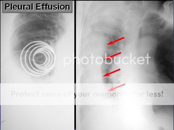 chest radiography interpretation Chestx-ray004