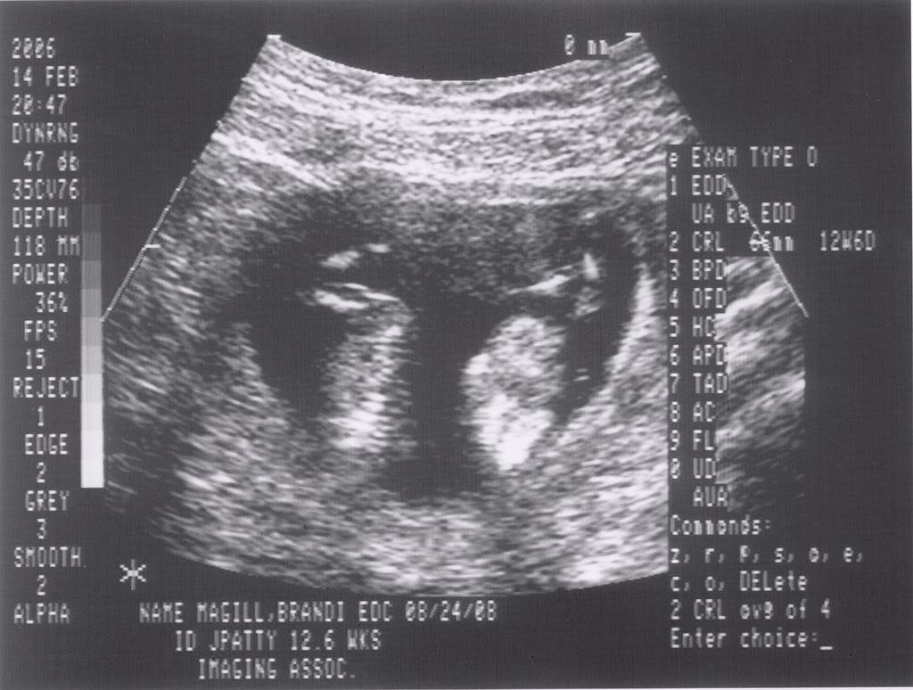 Ultrasound Pictures 010_10-1