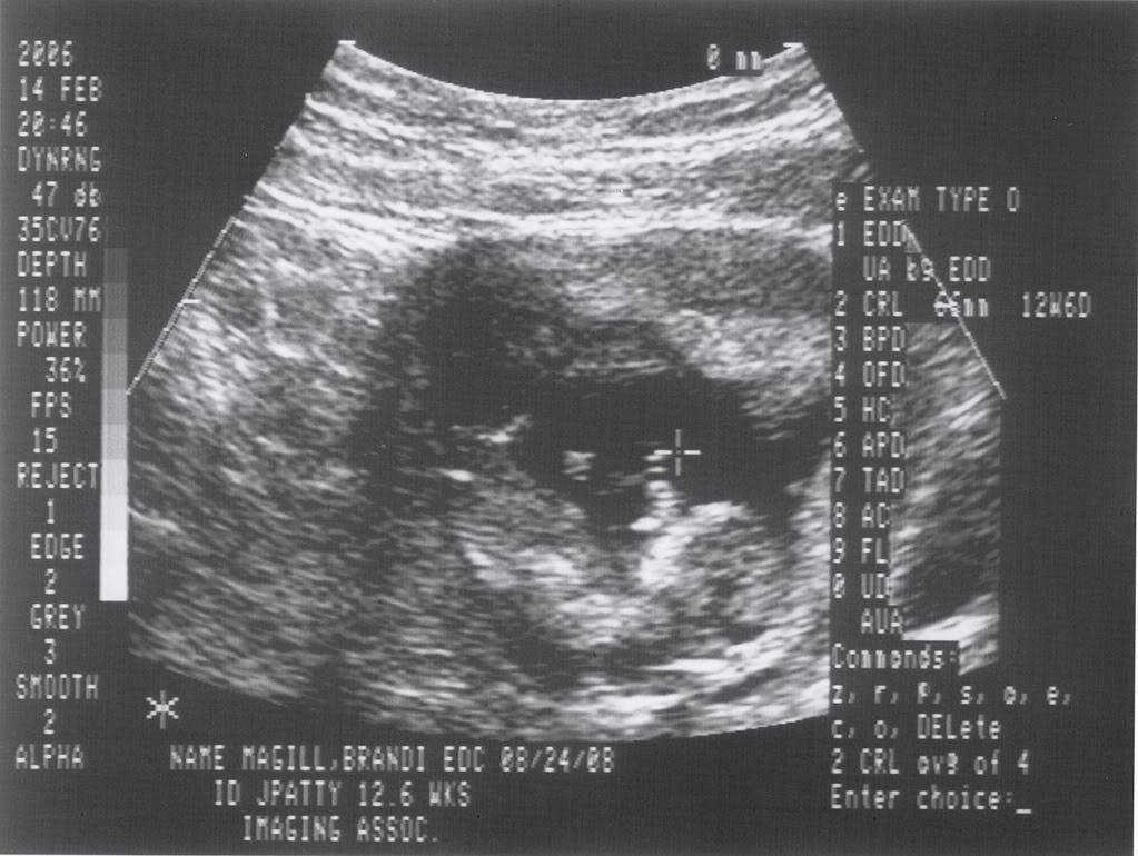 Ultrasound Pictures 011_11-1