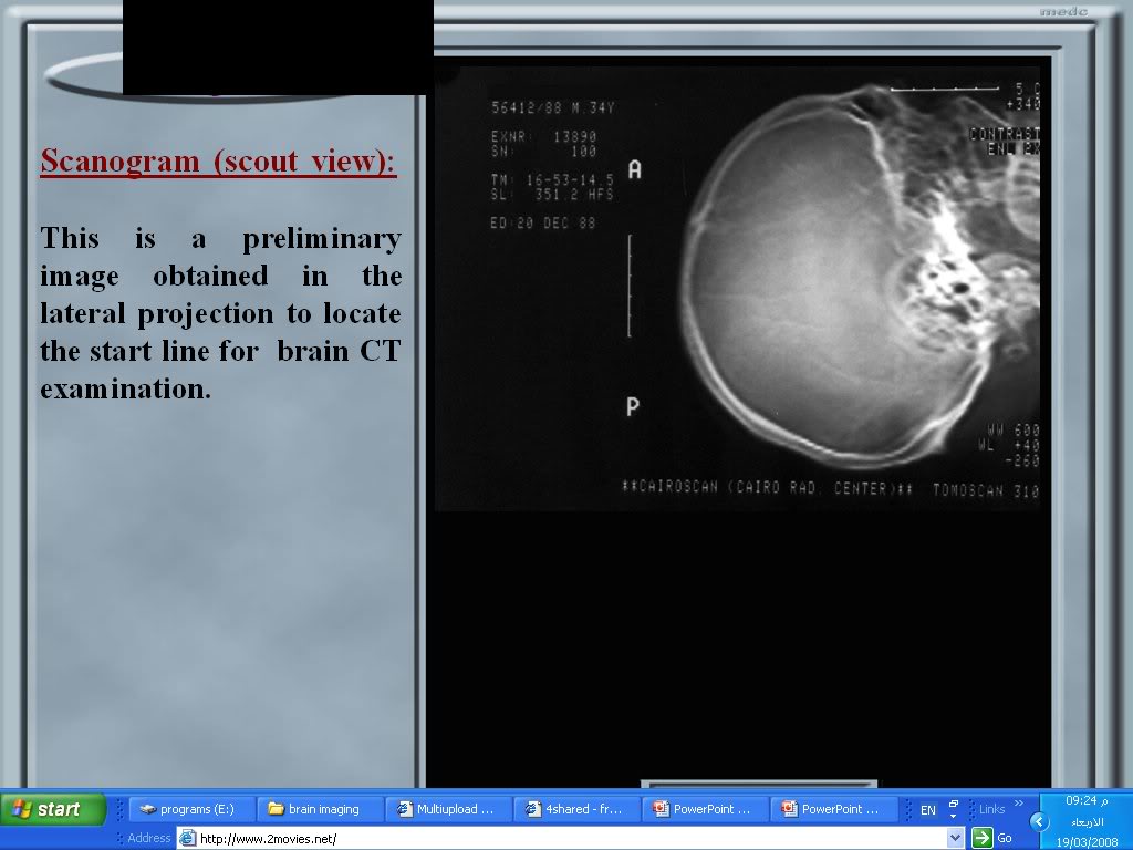 infarction,ischeamia or edema? images of brain make it clear Brainimaging