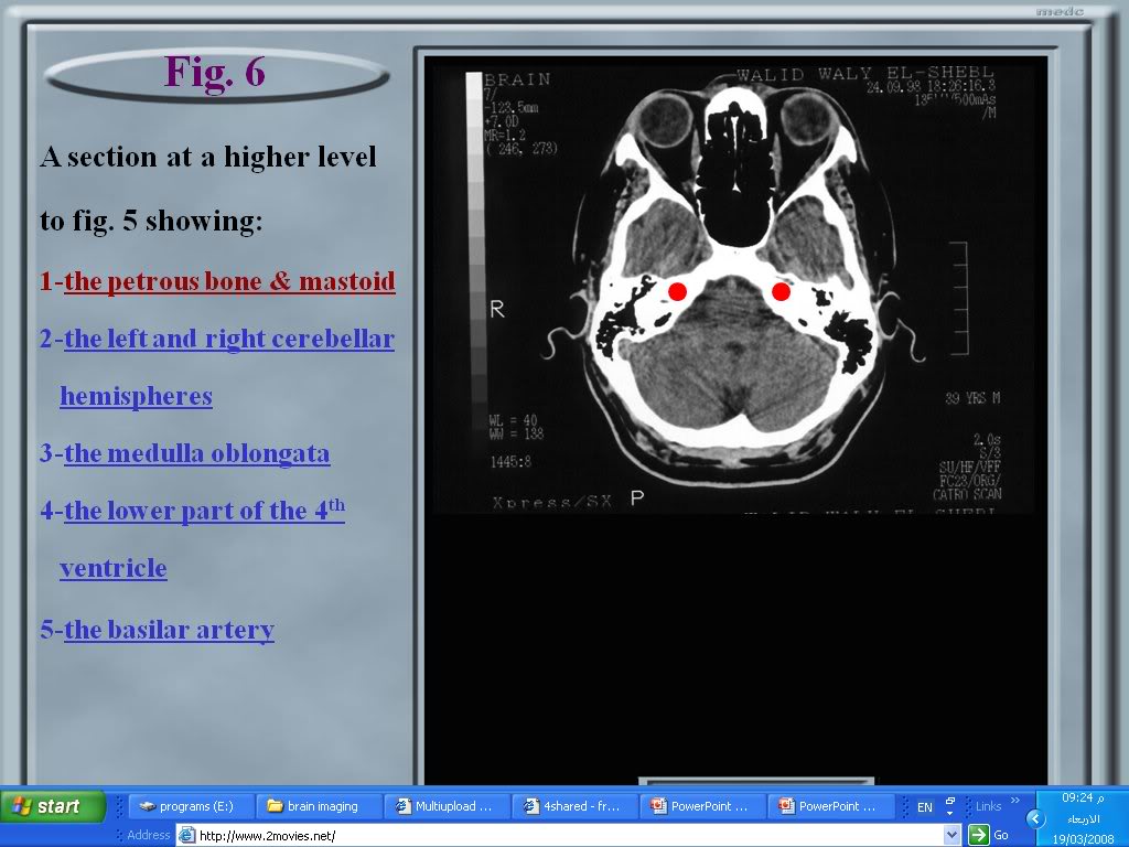 infarction,ischeamia or edema? images of brain make it clear Brainimaging002