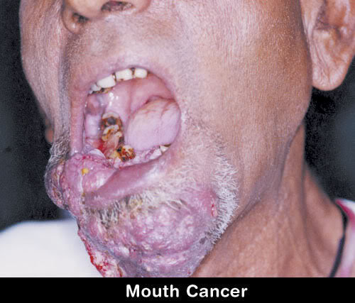 SMOKING Mouth_cancer2