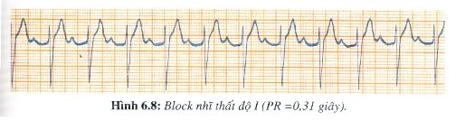 [kiến thức về..] BLOCK NHĨ THẤT  H608