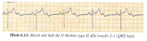 [kiến thức về..] BLOCK NHĨ THẤT  H613