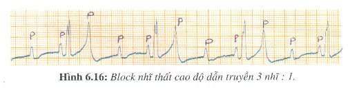 [kiến thức về..] BLOCK NHĨ THẤT  H616