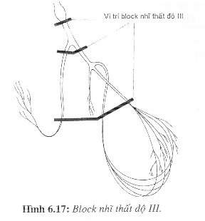 [kiến thức về..] BLOCK NHĨ THẤT  H617