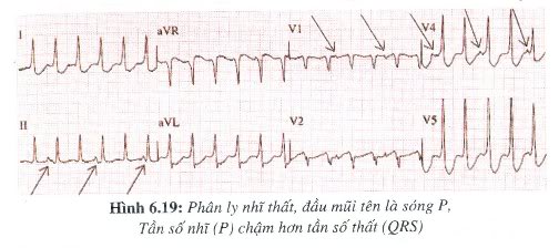 [kiến thức về..] BLOCK NHĨ THẤT  H619