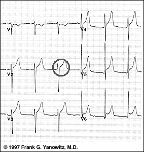 SPOT DIAGNOSIS -  5 Ecg_12lead004z