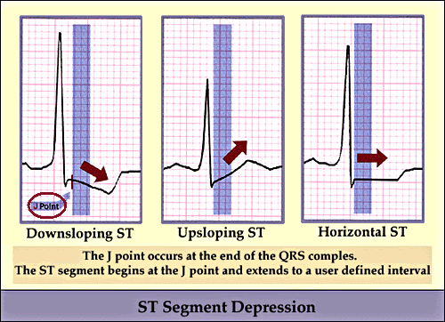 SPOT DIAGNOSIS -  5 Ecg_st