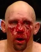 UFC 131 AV/sig bets Carwin_bloody_face1