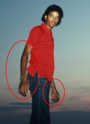 Michael Did NOT Change His Skin Color- He Had Vitiligo 11-4