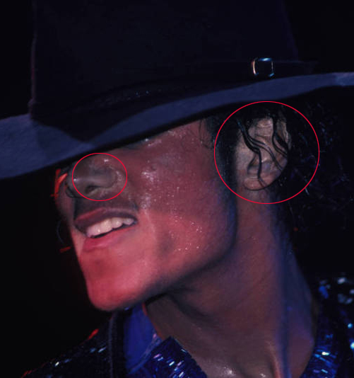 Michael Did NOT Change His Skin Color- He Had Vitiligo 25-2