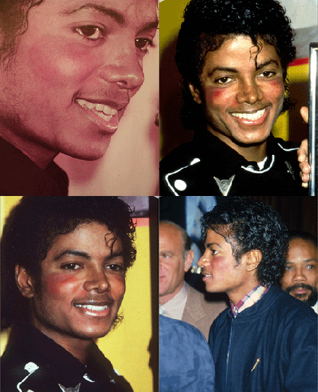 Michael - Michael Did NOT Change His Skin Color- He Had Vitiligo 2ljrntd