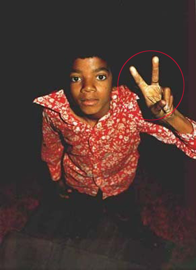 Michael - Michael Did NOT Change His Skin Color- He Had Vitiligo 3