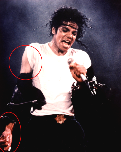 Michael Did NOT Change His Skin Color- He Had Vitiligo 31-2