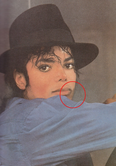 Michael - Michael Did NOT Change His Skin Color- He Had Vitiligo 36-1