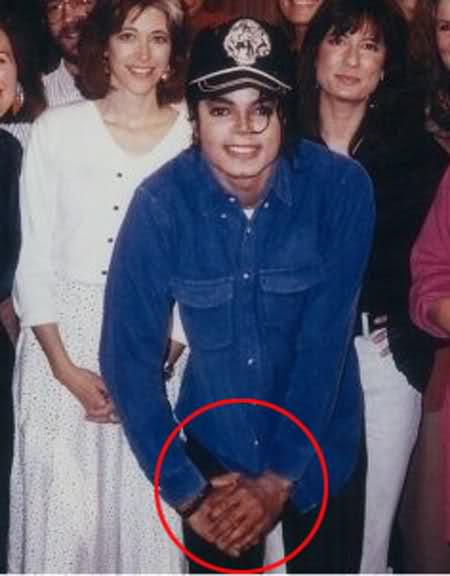 Michael - Michael Did NOT Change His Skin Color- He Had Vitiligo 38-1