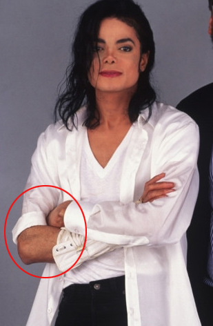 Michael Did NOT Change His Skin Color- He Had Vitiligo 45