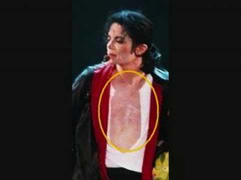 Michael - Michael Did NOT Change His Skin Color- He Had Vitiligo 57