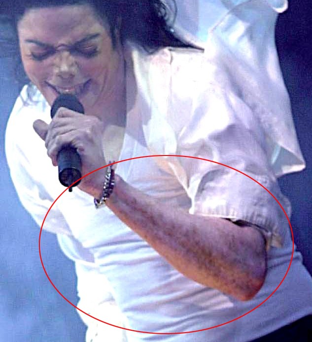 Michael Did NOT Change His Skin Color- He Had Vitiligo 58
