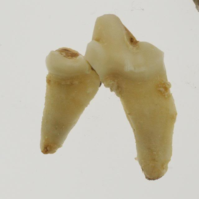 Dental work Side_molar