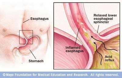 الحموضه وعلاجها Heartburn