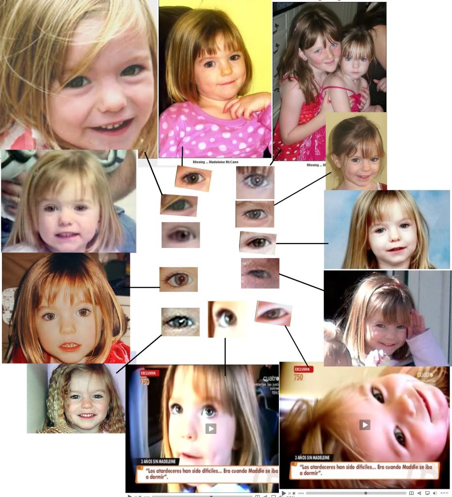 colobomaJust - The changing Coloboma of Madeleine Combined1