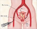 Mallotuf-s:Điều Trị U sơ tử cung,U nang buồng trứng và các Khối U lành tính  Ustcung2