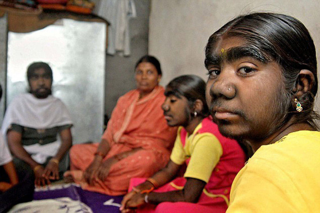 As irmãs lobisomem da Índia que sonham em se casar (5 fotos)  Leia mais em: As irmãs lobisomem da Índia que sonham em se casar (5 fotos)  Irmas_hipertricose_india_03