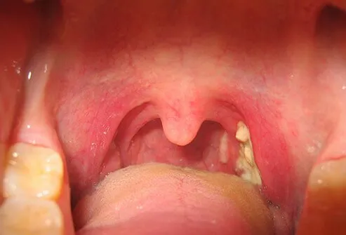 infectious mononucleosis article slideshow Mono_s9_throat