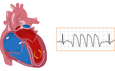 مراقب للقلب .. وصادم أيضا  Ventricular_tach