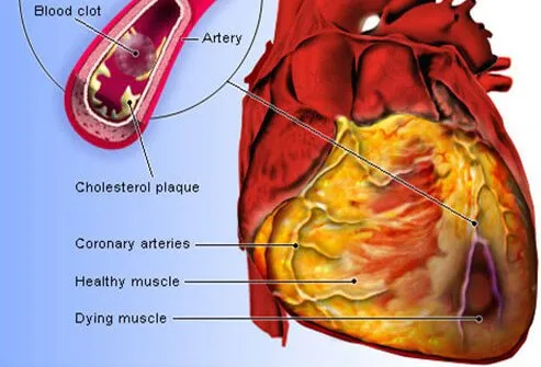 القلب Heart_disease_s3_heart_attack