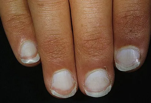 معلومات مهمة عن اظافرك نسومتى Nail_say_health_s3_white_nails