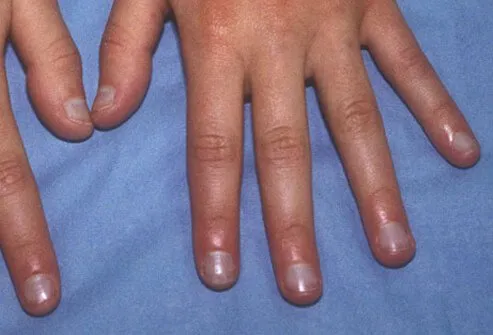 معلومات مهمة عن اظافرك نسومتى Nail_say_health_s5_acrocyanosis_of_hands